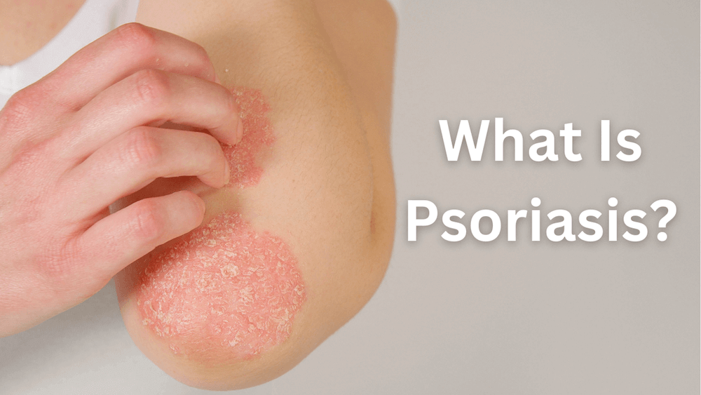 What-is-psoriasis