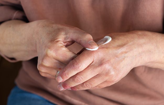 Applying ointment to hands with atopic dermatitis, eczema, allergy Elder woman applying moisturizing cream or ointment to her hands with atopic dermatitis, eczema, allergy reaction on dry skin